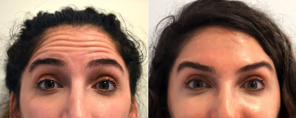 Botox For Under Eye Bags Cost Will It Really Fix Them And How Much - tcalju8