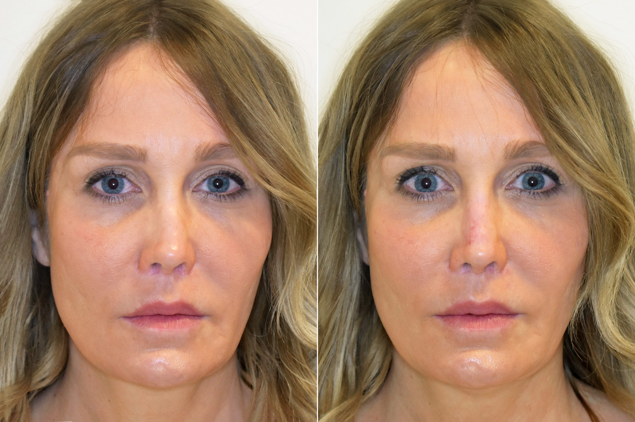 Dermal Fillers Philadelphia, PA Hyaluronic Acid Fillers