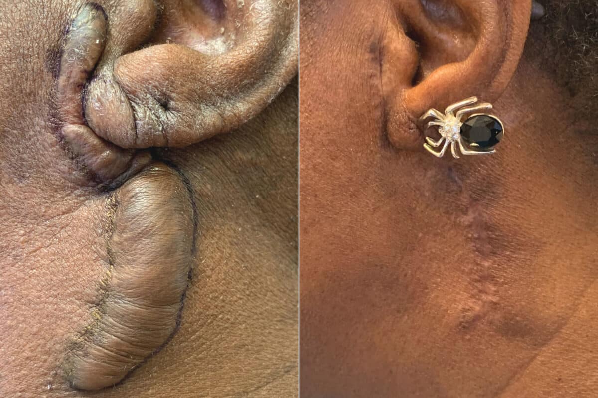 Patient 89, Scar Revision Before and After Photos Scar Revision Before and After Photos in , , Patient 89