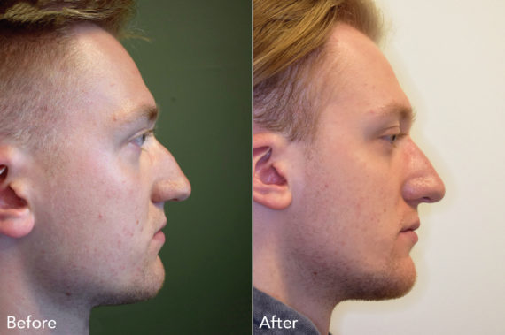 Rhinoplasty Before and After Photos in Philadelphia, PA, Patient 462