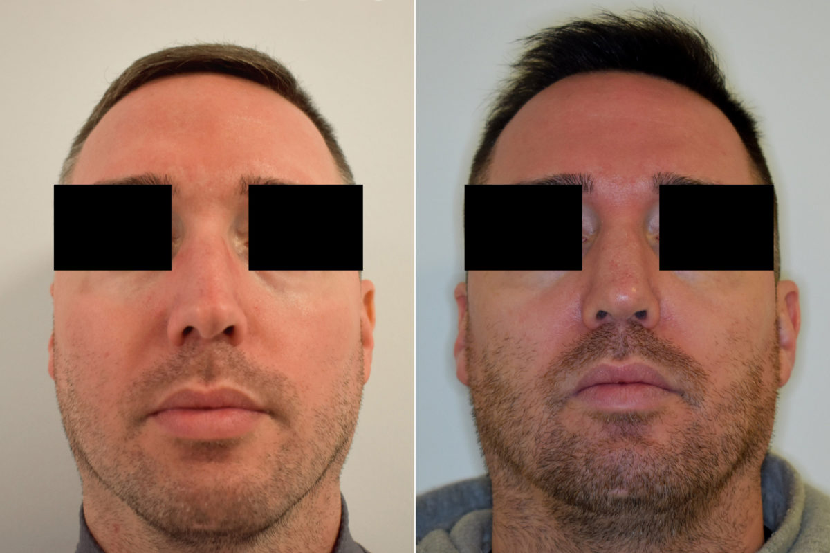 Patient 470, Rhinoplasty Before and After Photos Rhinoplasty Before and After Photos in Philadelphia, PA, Patient 470