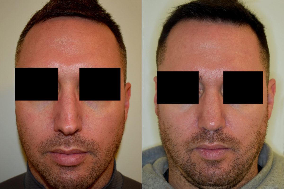 Patient 470, Rhinoplasty Before and After Photos Rhinoplasty Before and After Photos in Philadelphia, PA, Patient 470
