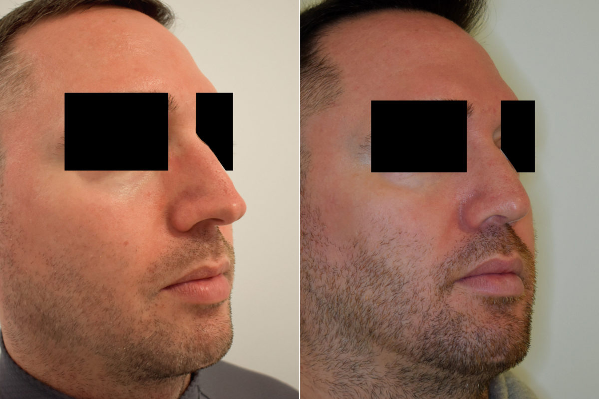 Patient 470, Rhinoplasty Before and After Photos Rhinoplasty Before and After Photos in Philadelphia, PA, Patient 470