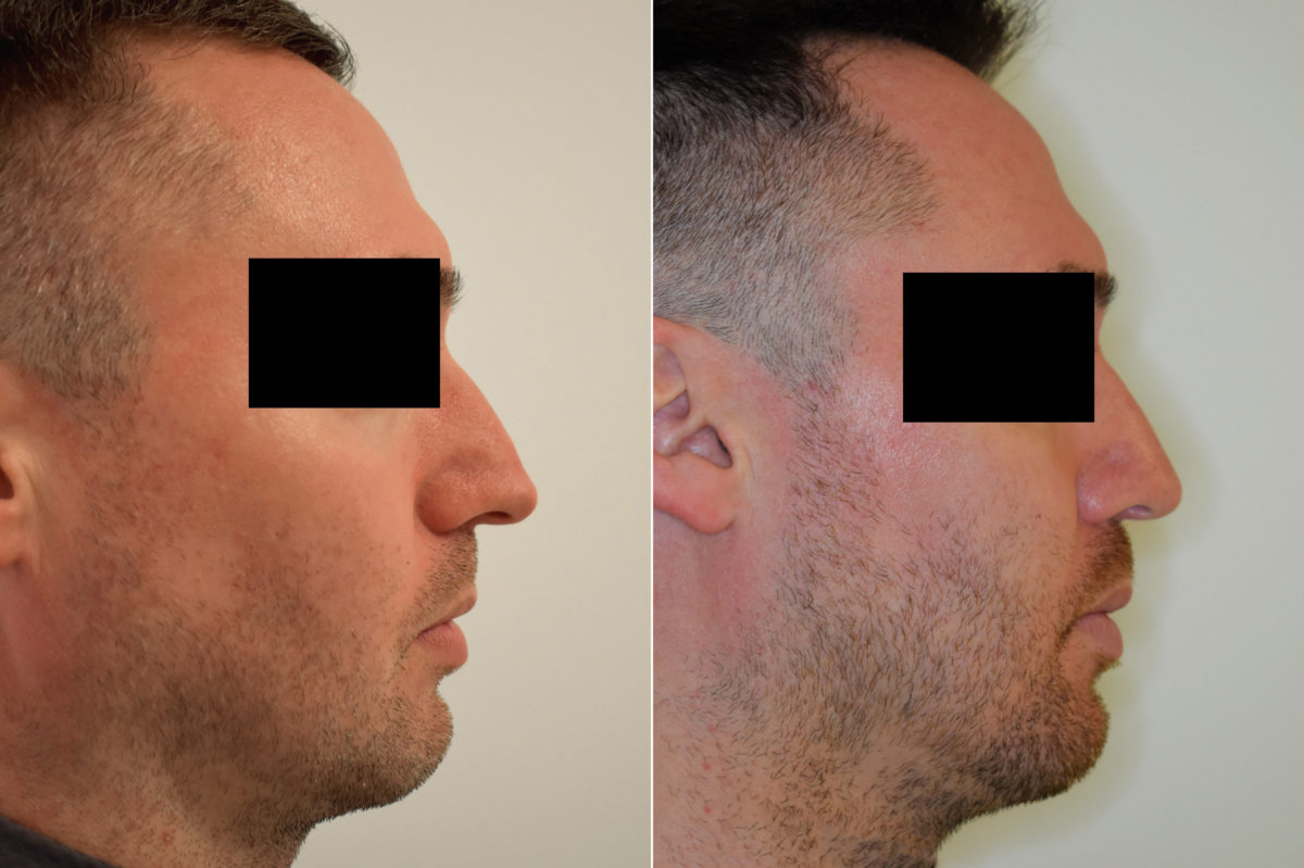 Patient 470, Rhinoplasty Before and After Photos Rhinoplasty Before and After Photos in Philadelphia, PA, Patient 470