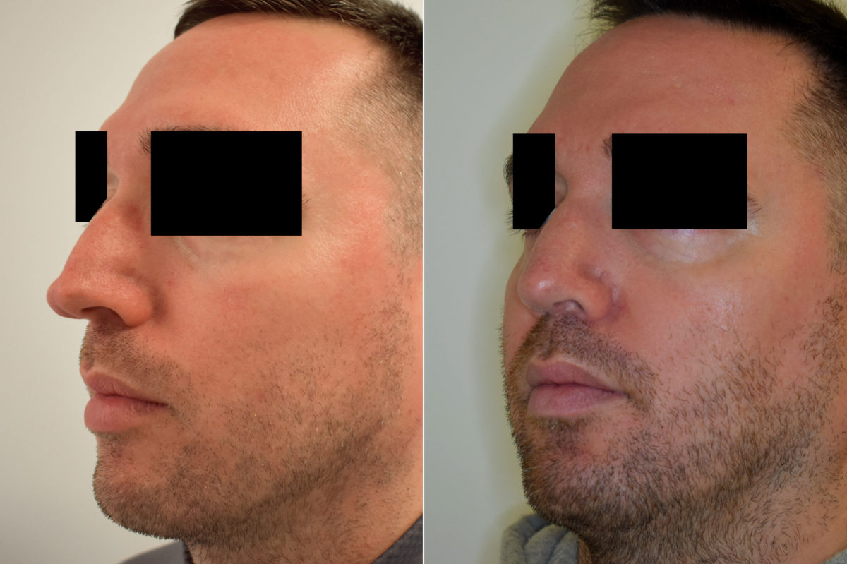 Patient 470, Rhinoplasty Before and After Photos Rhinoplasty Before and After Photos in Philadelphia, PA, Patient 470