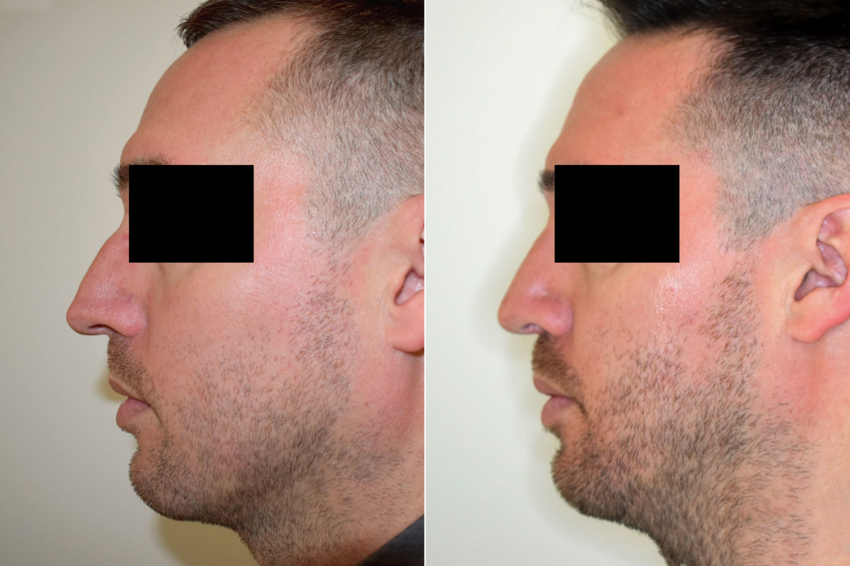 Patient 470, Rhinoplasty Before and After Photos Rhinoplasty Before and After Photos in Philadelphia, PA, Patient 470