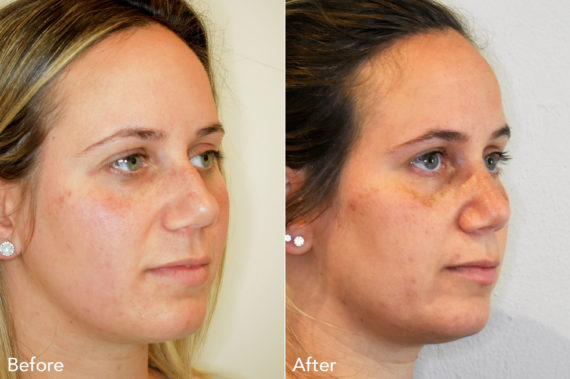 Rhinoplasty Before and After Photos in Philadelphia, PA, Patient 510