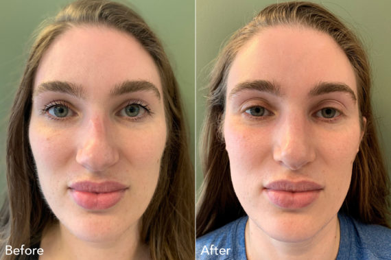 Rhinoplasty Before and After Photos in Philadelphia, PA, Patient 553