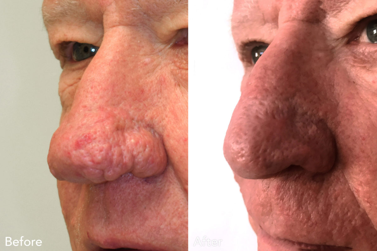 Patient 79, Rhinophyma Before and After Photos Rhinophyma Before and After Photos in , , Patient 79