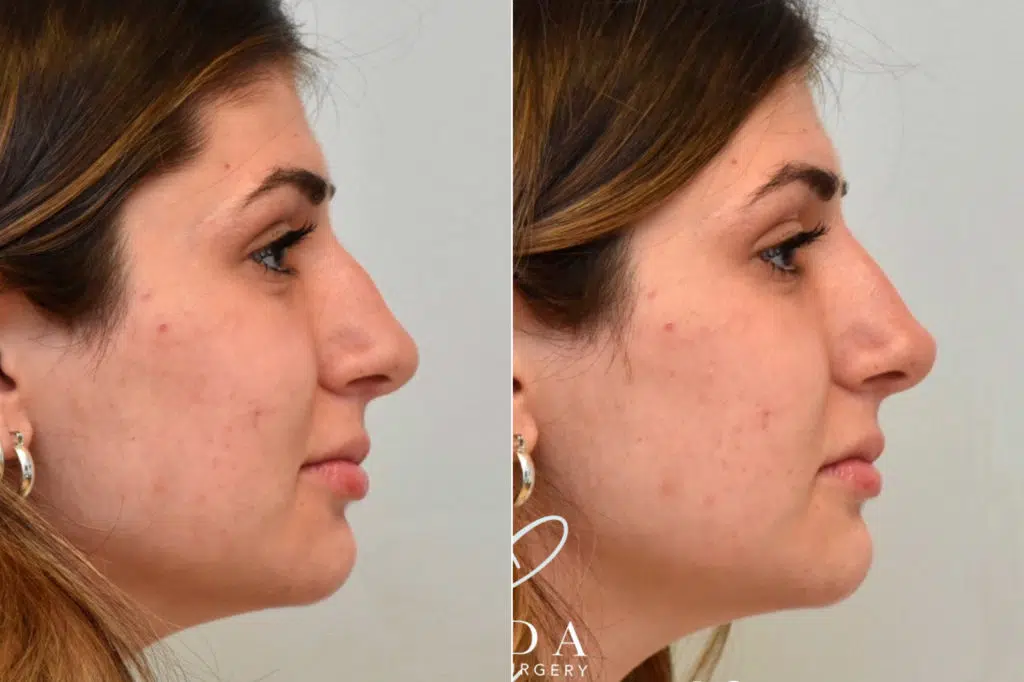 Liquid Rhinoplasty photos Philadelphia, PA Patient 1292