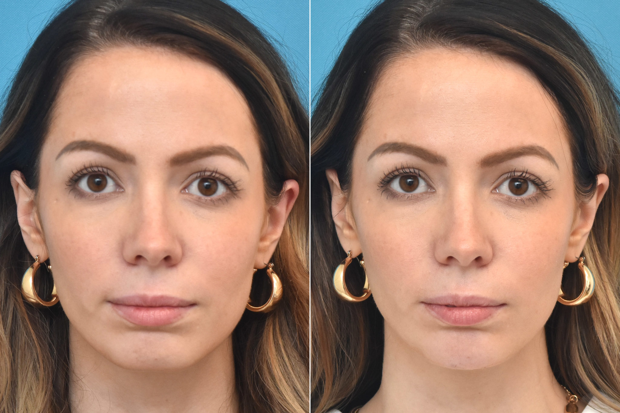 Injectable Fillers Photos Philadelphia Pa Patient 1368 