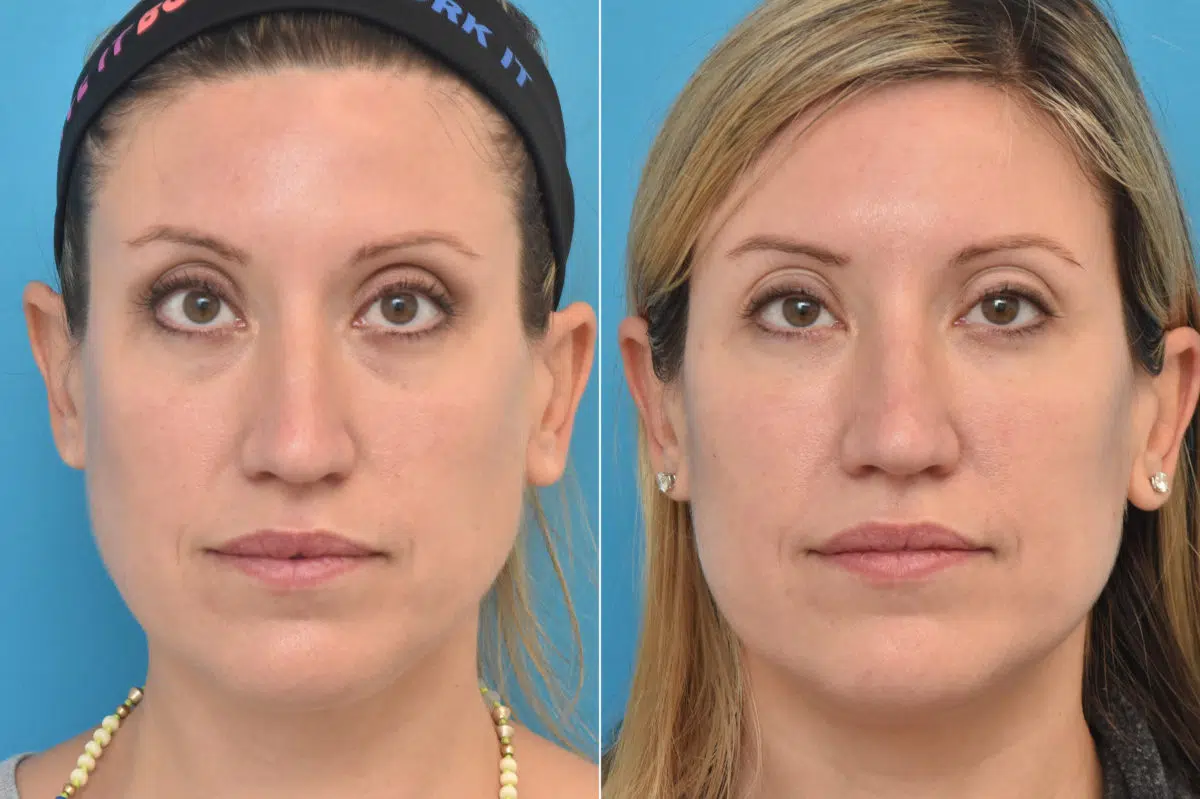 Injectable Fillers Before and After Photos in Philadelphia, PA, Patient 1569