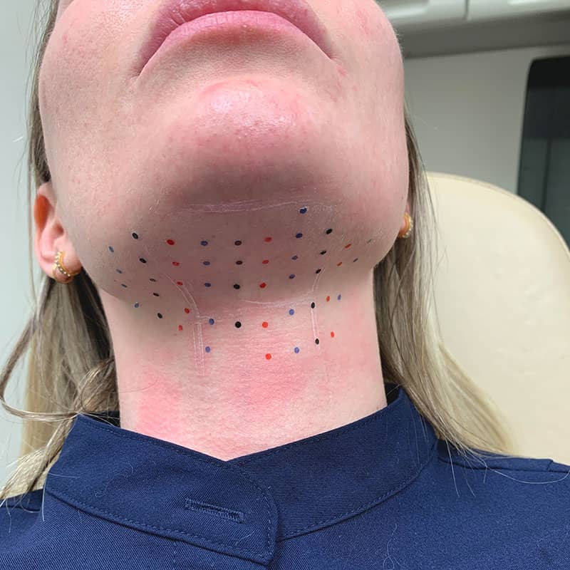 Kybella is the only FDA approved non-surgical treatment of the fat below the chin (submental fat).