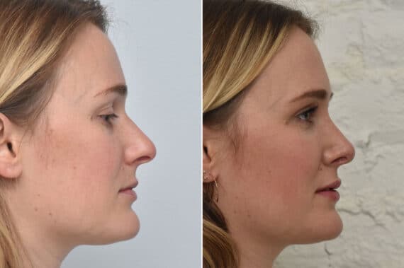 Rhinoplasty Before and After Photos in Philadelphia, PA, Patient 1465