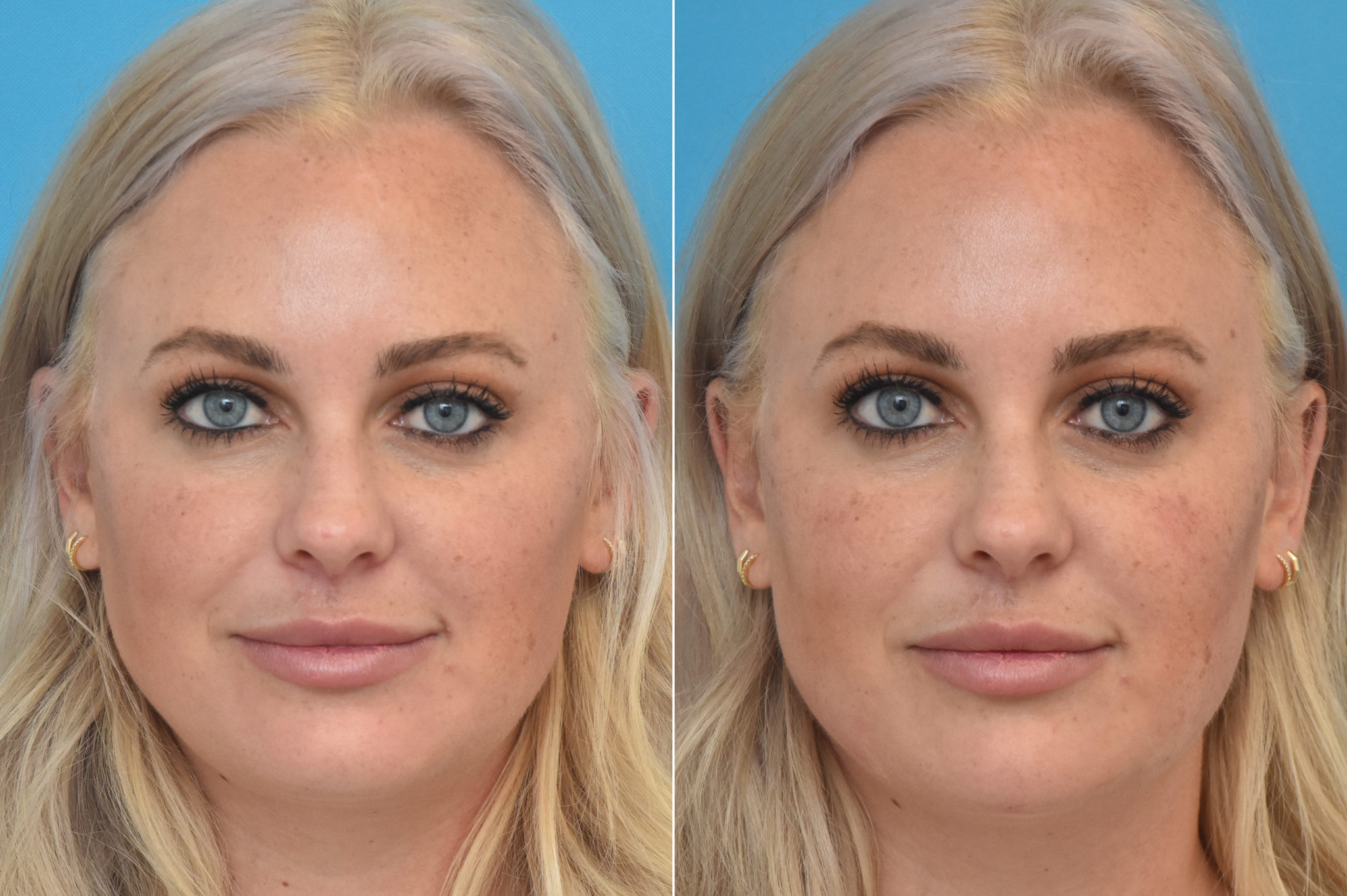 Injectable Fillers Photos Philadelphia Pa Patient 1553 7257