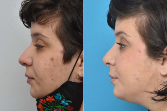 Rhinoplasty Before and After Photos in Philadelphia, PA, Patient 2267