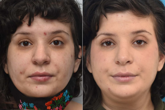 Rhinoplasty Before and After Photos in Philadelphia, PA, Patient 2267