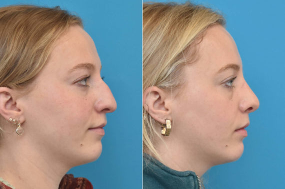 Rhinoplasty Before and After Photos in Philadelphia, PA, Patient 2274