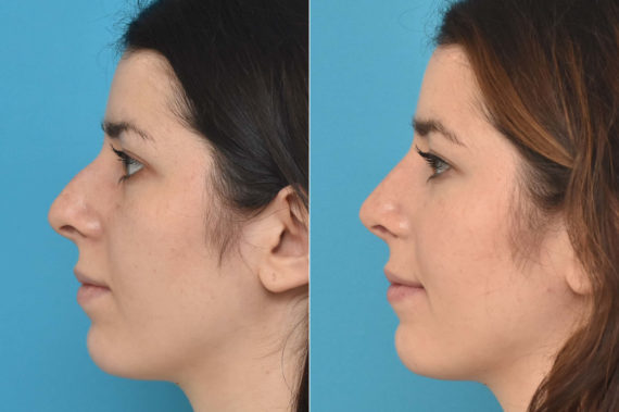 Rhinoplasty Before and After Photos in Philadelphia, PA, Patient 2284