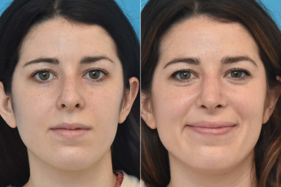 Rhinoplasty Before and After Photos in Philadelphia, PA, Patient 2284