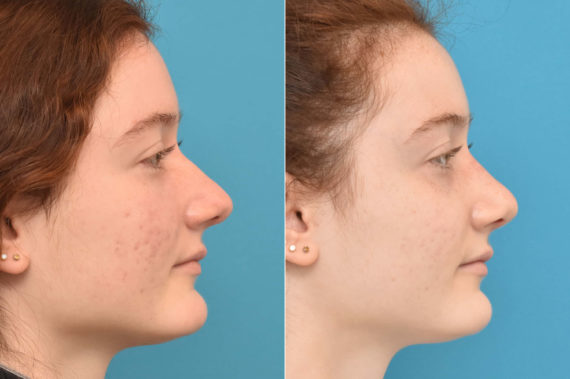 Rhinoplasty Before and After Photos in Philadelphia, PA, Patient 2291