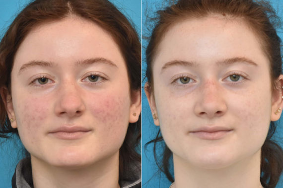 Rhinoplasty Before and After Photos in Philadelphia, PA, Patient 2291