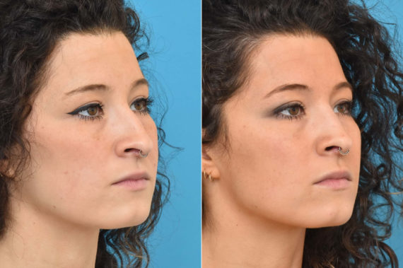 Rhinoplasty Before and After Photos in Philadelphia, PA, Patient 2301