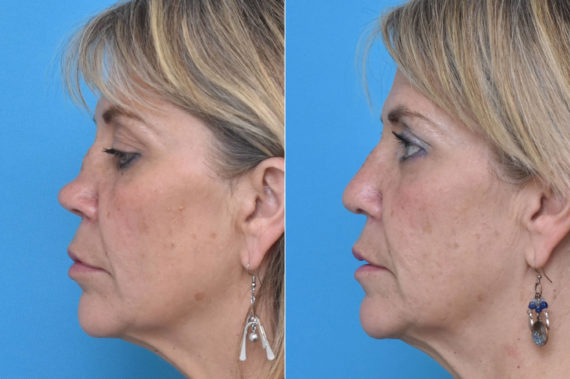 Rhinoplasty Before and After Photos in Philadelphia, PA, Patient 2311