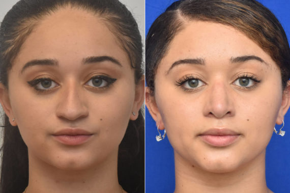 Rhinoplasty Before and After Photos in Philadelphia, PA, Patient 2327