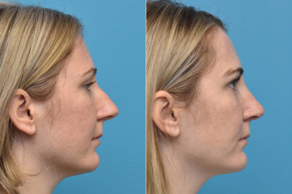 Rhinoplasty Before and After Photos in Philadelphia, PA, Patient 2337