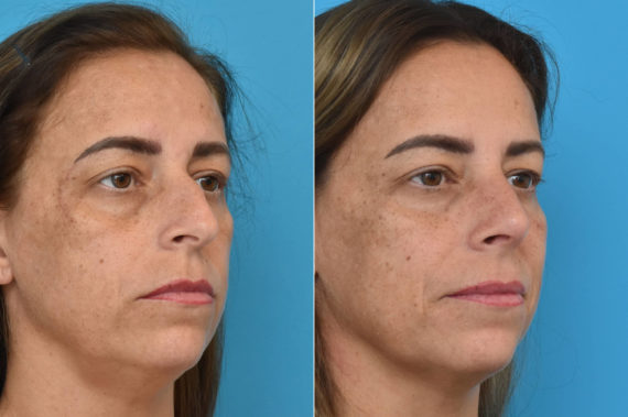 Rhinoplasty Before and After Photos in Philadelphia, PA, Patient 2370