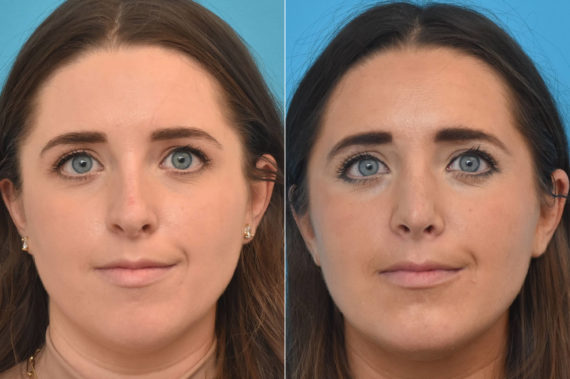 Rhinoplasty Before and After Photos in Philadelphia, PA, Patient 2383