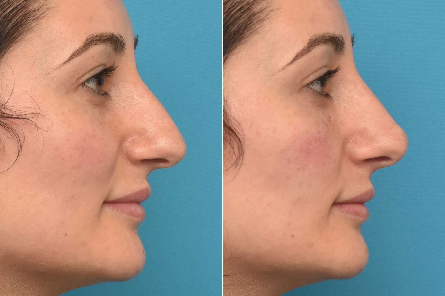Before and After Photos - Kirk Lozada, MD, Facial Plastic Surgery
