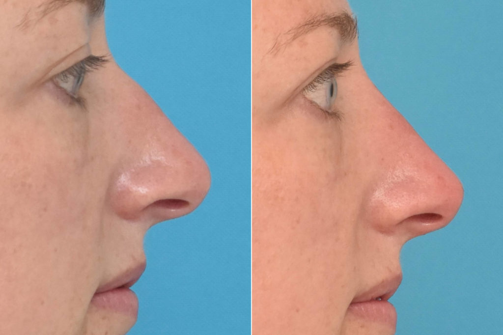 Liquid Rhinoplasty photos Philadelphia, PA Patient 2526