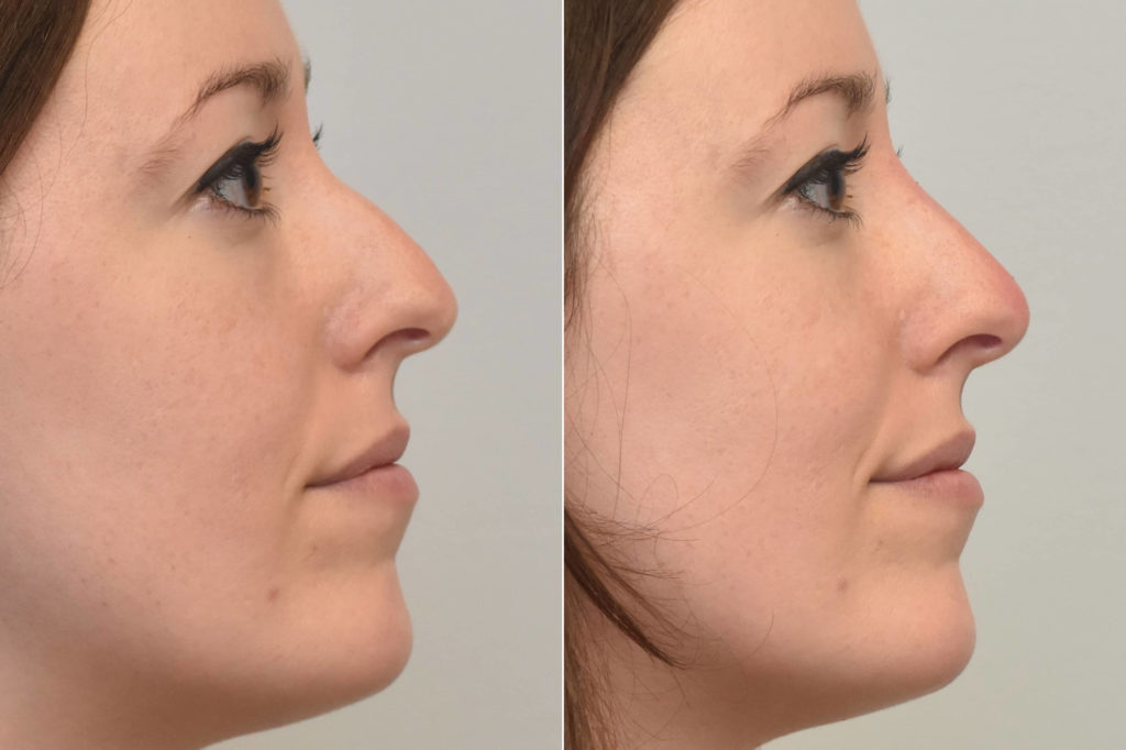 Liquid Rhinoplasty Philadelphia Non Surgical Nose Reshaping