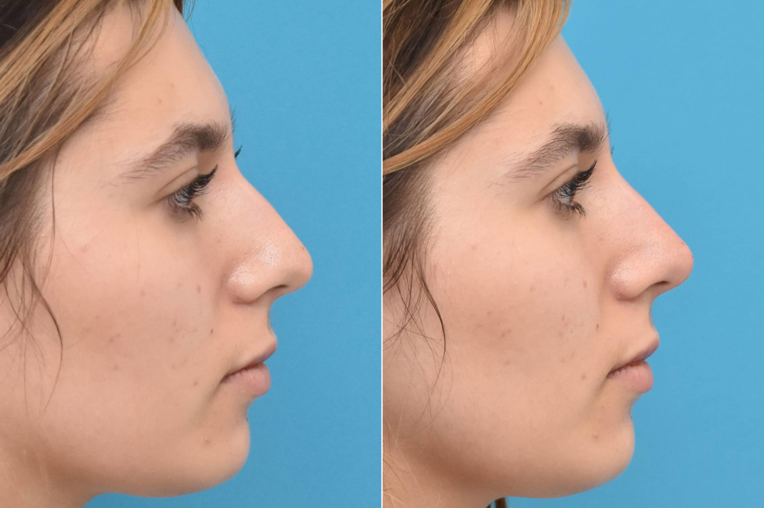 Liquid Rhinoplasty Philadelphia Non Surgical Nose Reshaping