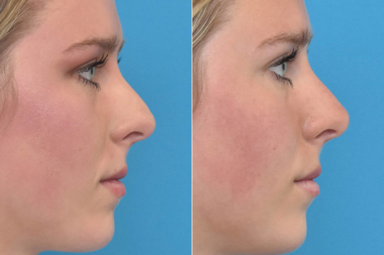 Before and After Photos - Kirk Lozada, MD, Facial Plastic Surgery