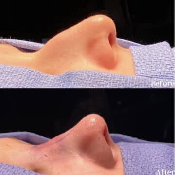 Immediate Rhinoplasty Before and After Photos in Philadelphia, PA, Patient 2612