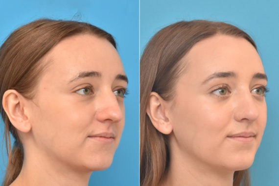 Rhinoplasty Before and After Photos in Philadelphia, PA, Patient 3210