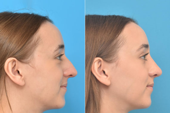 Rhinoplasty Before and After Photos in Philadelphia, PA, Patient 3210