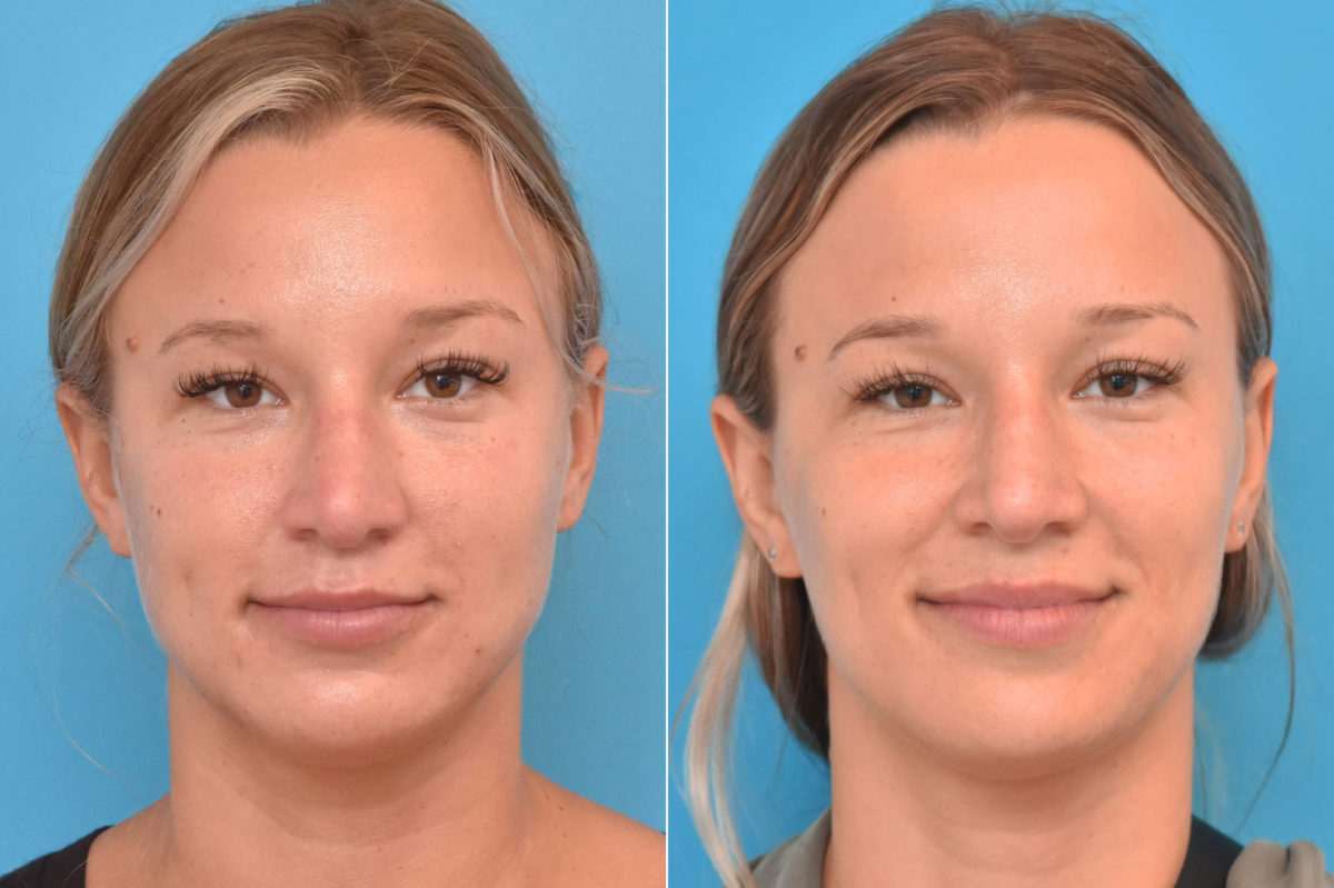 Rhinoplasty Before and After Photos in Philadelphia, PA, Patient 3220