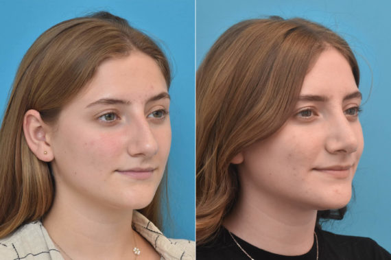 Rhinoplasty Before and After Photos in Philadelphia, PA, Patient 3239