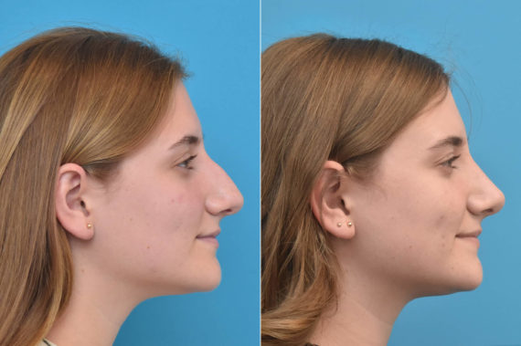 Rhinoplasty Before and After Photos in Philadelphia, PA, Patient 3239