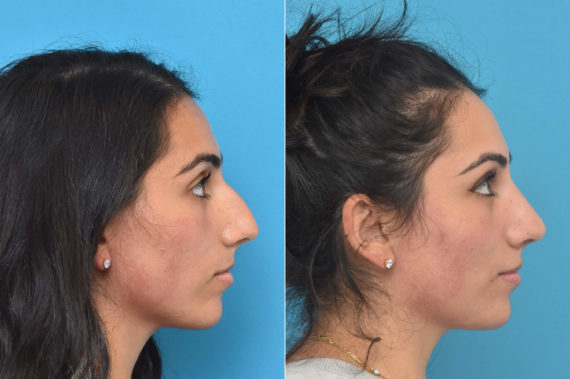 Rhinoplasty Before and After Photos in Philadelphia, PA, Patient 3249