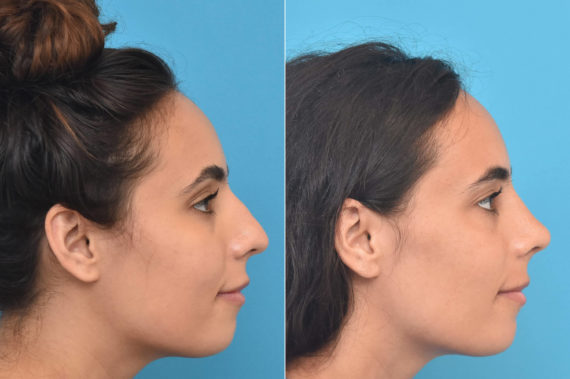 Rhinoplasty Before and After Photos in Philadelphia, PA, Patient 3269