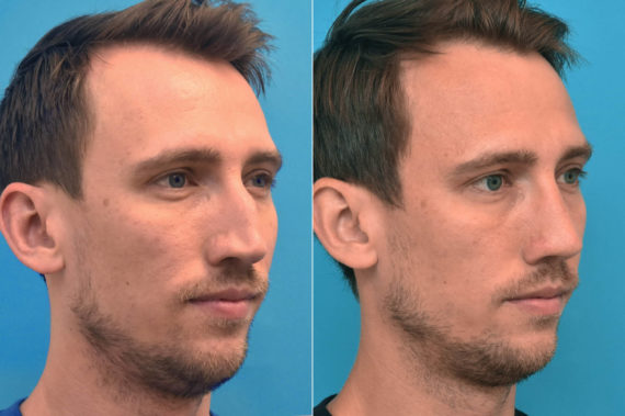 Rhinoplasty Before and After Photos in Philadelphia, PA, Patient 3302