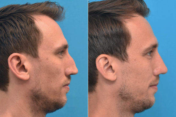 Rhinoplasty Before and After Photos in Philadelphia, PA, Patient 3302