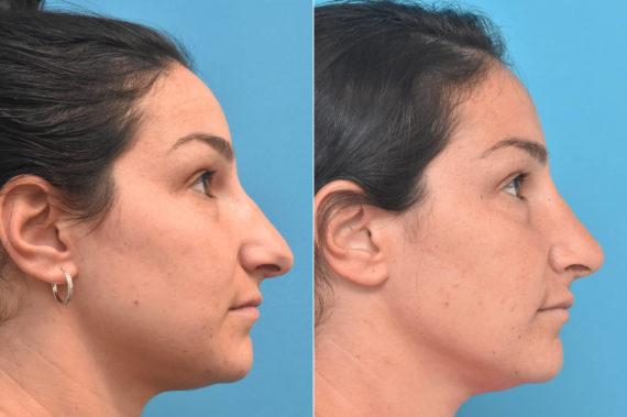 Rhinoplasty Before and After Photos in Philadelphia, PA, Patient 3312