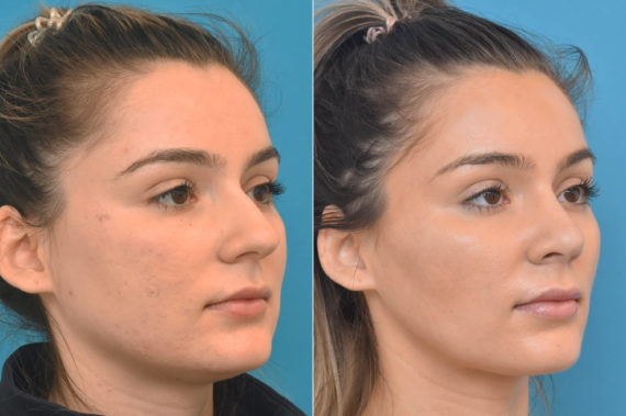 Rhinoplasty Before and After Photos in Philadelphia, PA, Patient 3322
