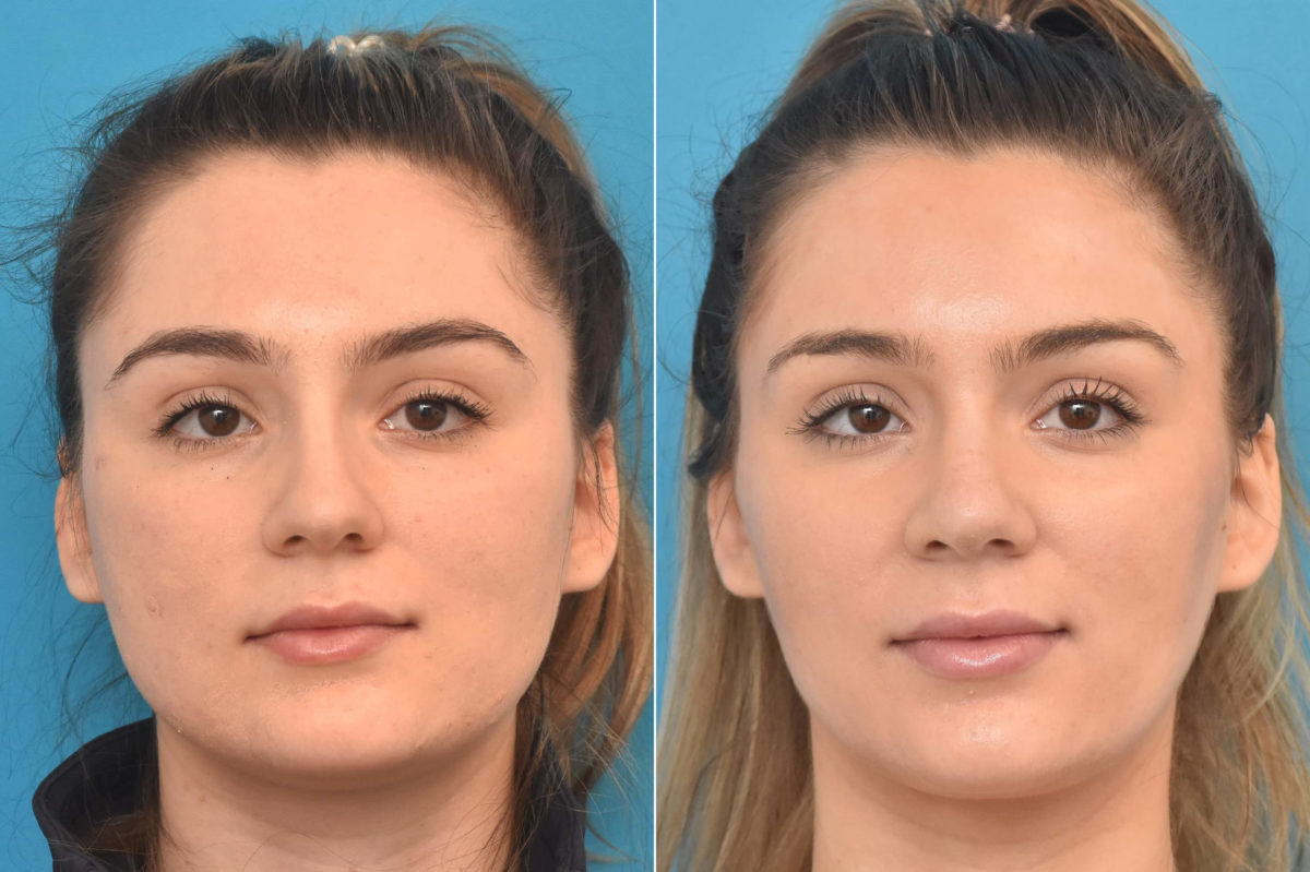 Rhinoplasty Before and After Photos in Philadelphia, PA, Patient 3322